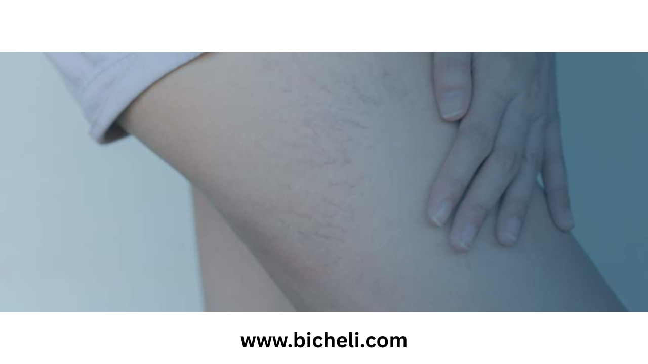 How Pregnancy Can Lead to Varicose Veins and What You Can Do About It